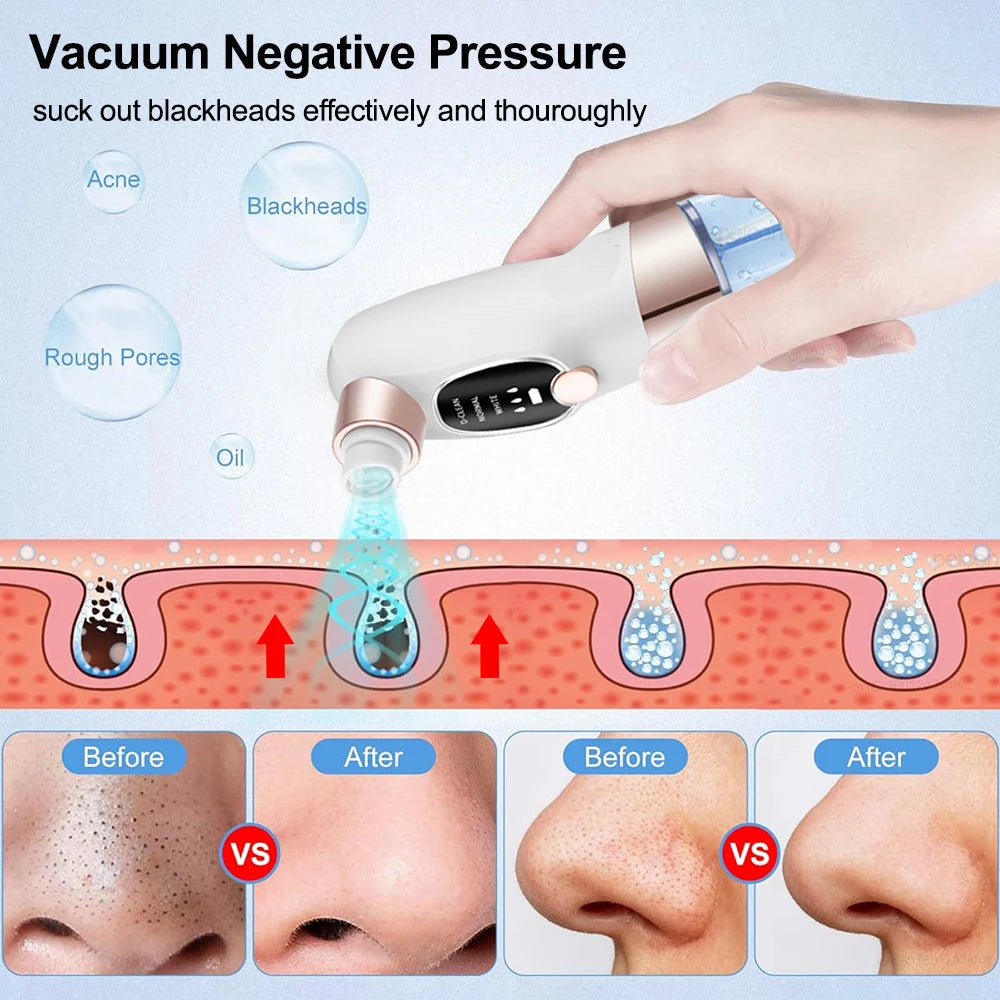PoreVac Pro™ – Nettoyeur de Pores et Éliminateur de Points Noirs